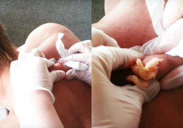 Watch A 30-Year-Old Cyst Get Popped