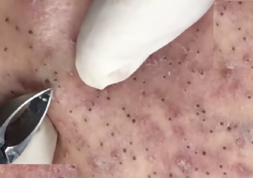 Watch: Acne Extraction on Face- Close Up!