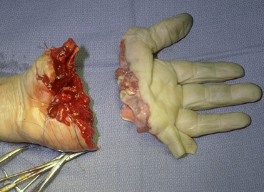 Watch: Amputated Hand Re-Implantation Surgery