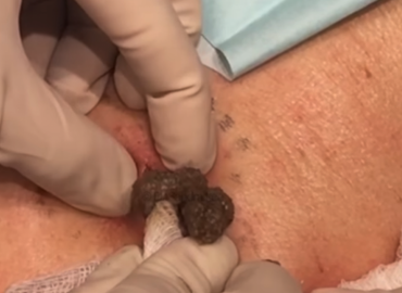 Watch : Black Zit Excised On The Back