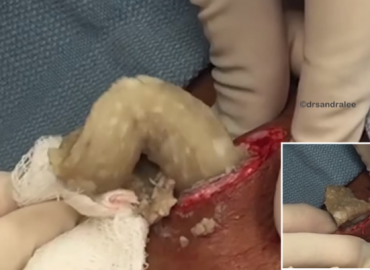 Watch: CEASE & DE-CYST Removal !!