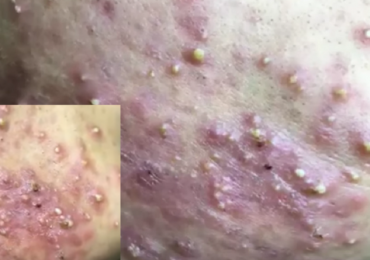 Watch: Cystic Acne Extraction on the face