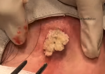 Watch : Epidermoid Cyst On Cheek By Dr Pimple Popper