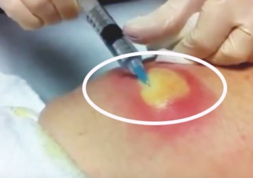 Watch: Giant Pimple Popping
