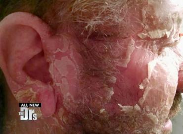 Watch: Help for Man with Extreme Eczema