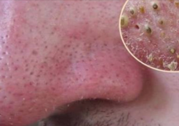 Watch: How to Remove Blackheads Fast