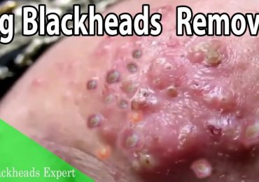 Watch : Large Blackheads Extraction
