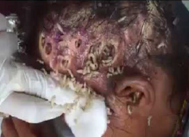 WATCH: Maggots eating up this woman’s head
