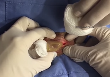 WATCH : Milk Incision & Drainage From Neck