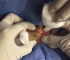 WATCH : Milk Incision & Drainage From Neck