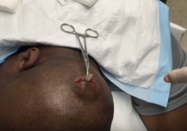 Watch : Pilar Cyst Removed From Head