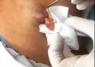 Watch: Popping Huge Cyst and Extraction