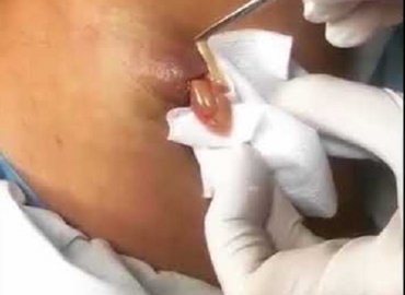 Watch: Popping Huge Cyst and Extraction