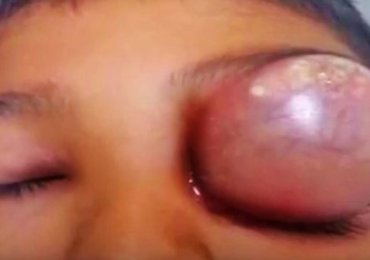 Watch: The Worst Eye Cyst Draining