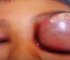 Watch: The Worst Eye Cyst Draining