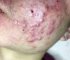 Watch videos about Acne Extraction on the Face