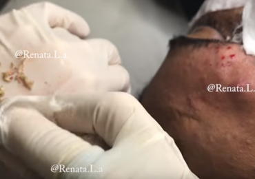 WATCH : Whiteheads & Blackheads Extraction