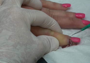 Watch: Worst Nail Infections of All Time..!