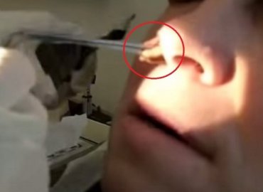 What Doctors Pulled Out From This Guy’s 