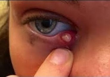 Woman Popping Giant cyst at the Eye 