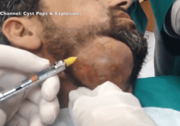 World’s Largest Face Cyst Popped