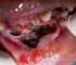 Worms Living Inside Teeth Cavity Removal..!!