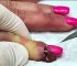 Worst Nail Infections of All Time