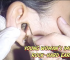 Young Woman’s Impacted Rock-Hard Earwax Removal