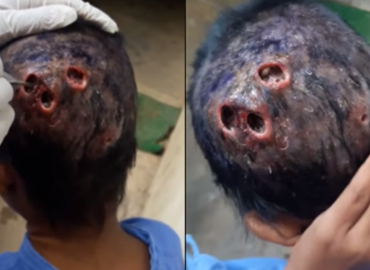 This Child Had Maggot Infested Wound On His Head