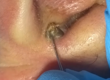 This Is Awesome.. Big Blackheads In Ear