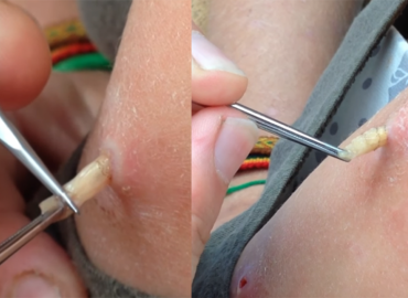 WATCH : Botfly Removal From Young Woman’s Arm
