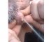 Watch: Pop Whiteheads and Cysts Home Removal